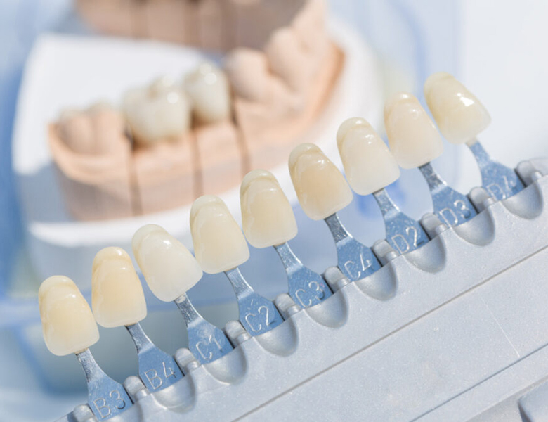 吉祥寺の歯医者、吉祥寺壱番館歯科医院の詰め物・被せ物