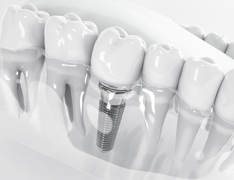 吉祥寺の歯医者、吉祥寺壱番館歯科医院のインプラント