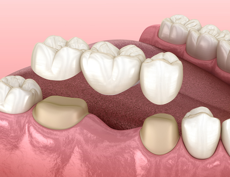 吉祥寺の歯医者、吉祥寺壱番館歯科医院のブリッジ