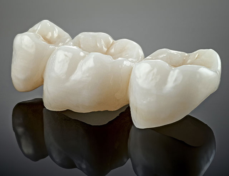 吉祥寺の歯医者、吉祥寺壱番館歯科医院のブリッジ