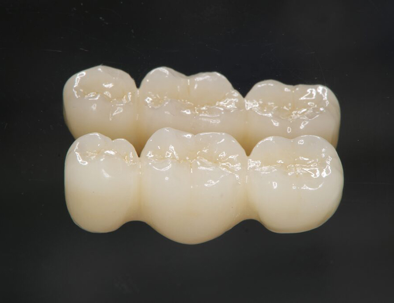 吉祥寺の歯医者、吉祥寺壱番館歯科医院のブリッジ