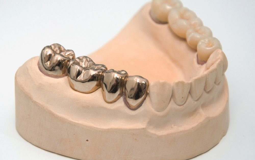 吉祥寺の歯医者、吉祥寺壱番館歯科医院のブリッジ