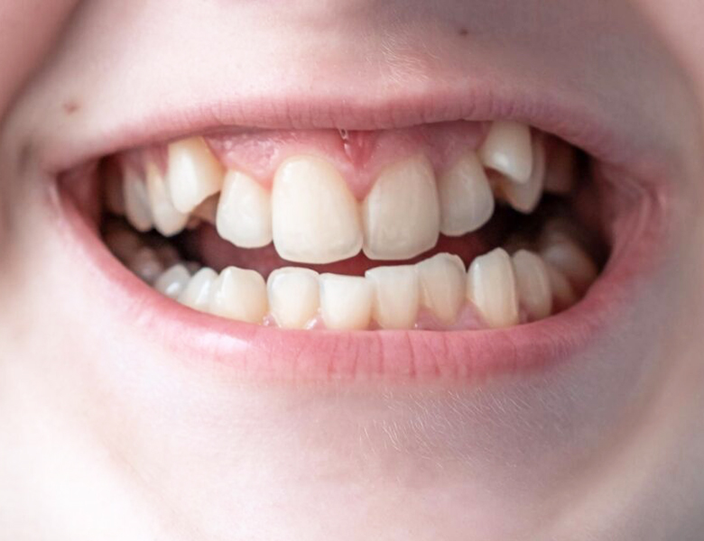 吉祥寺の歯医者、吉祥寺壱番館歯科医院の小児矯正