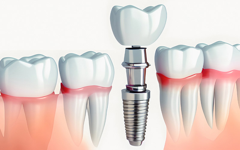 吉祥寺の歯医者、吉祥寺壱番館歯科医院でインプラント