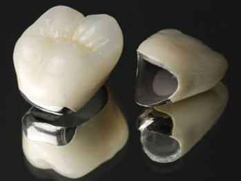 吉祥寺の歯医者、吉祥寺壱番館歯科医院の詰め物・被せ物