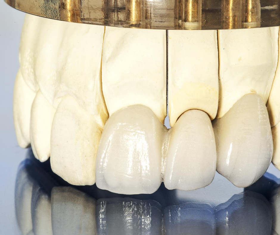 吉祥寺の歯医者、吉祥寺壱番館歯科医院の詰め物・被せ物