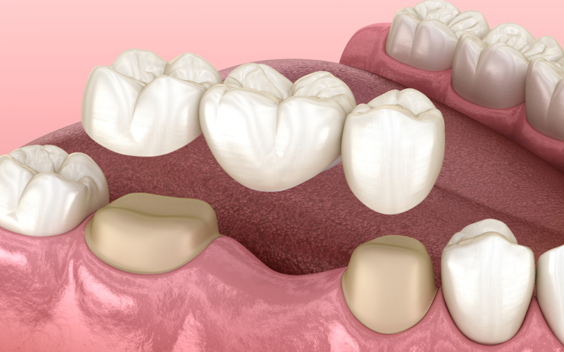 吉祥寺の歯医者、吉祥寺壱番館歯科医院のブリッジ